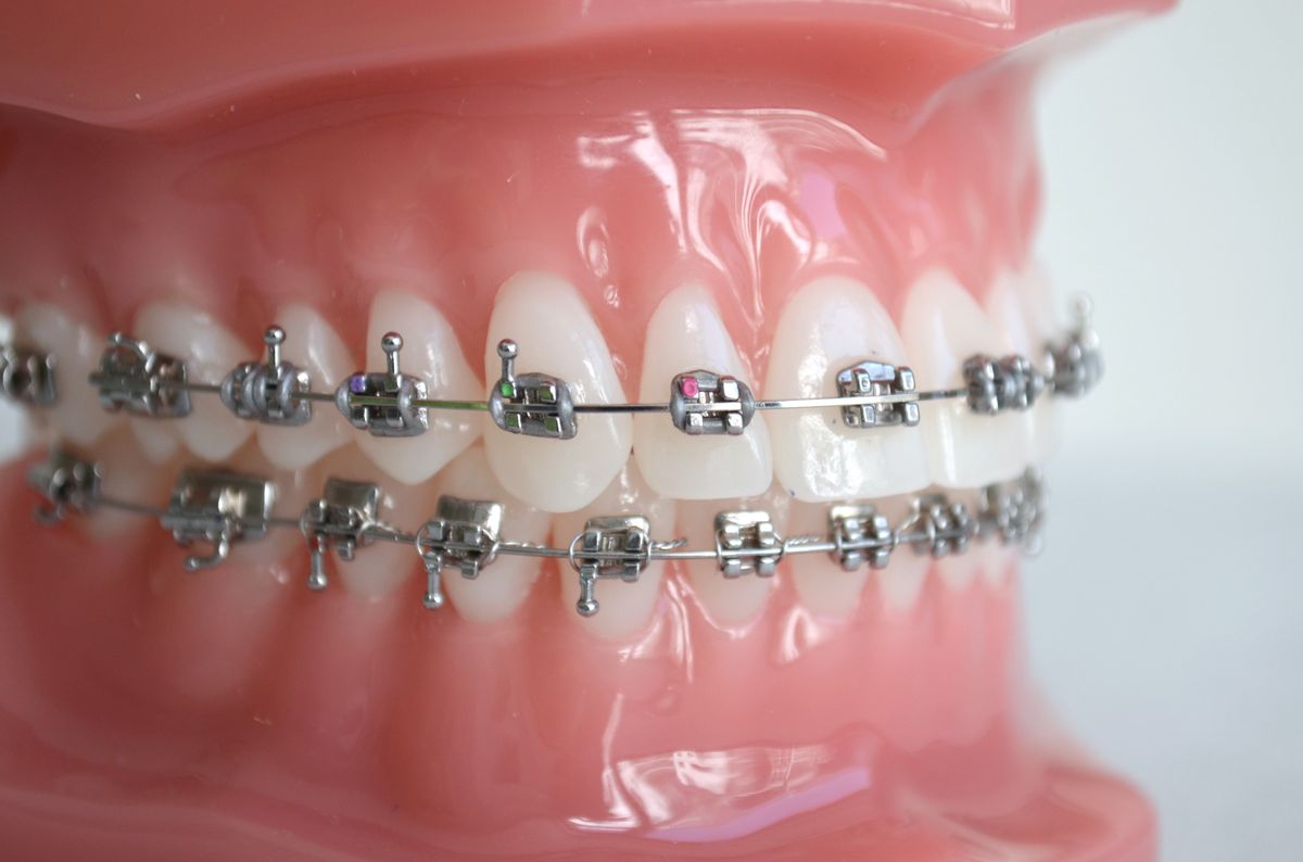 Zahnspange mit Metallbrackets