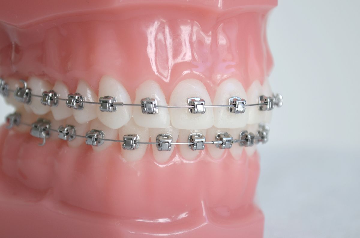 Modell eines Kiefers mit einer DAMON Zahnspange