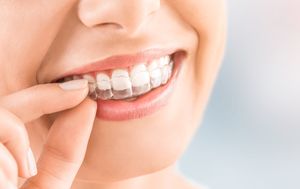 Frau legt sich eine transparente Schiene (Aligner) ein.